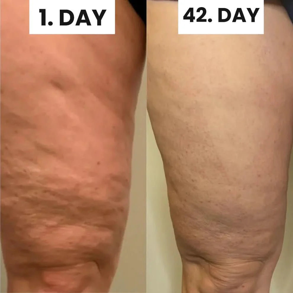 Cellulite Transformation System